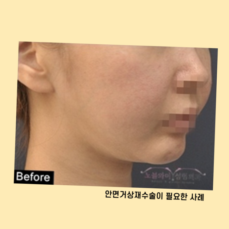  노블와이 안면거상재수술 다시 리프팅효과 볼 수 있어요