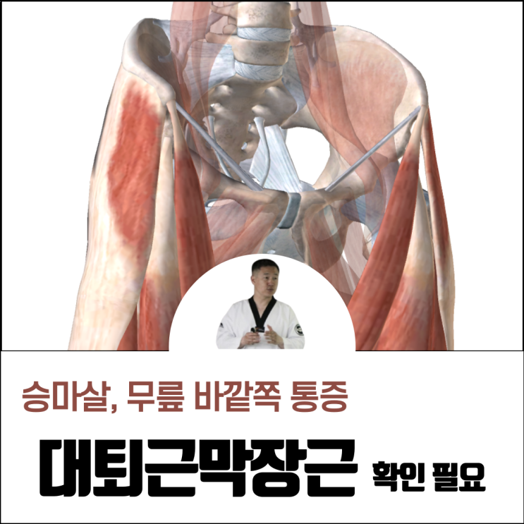  대퇴근막장근 승마살 무릎 바깥쪽 통증과 관련 (운동, 스트레칭)