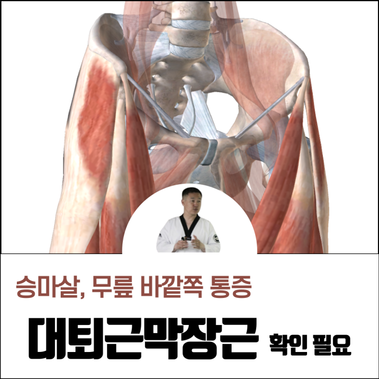 대퇴근막장근 승마살 무릎 바깥쪽 통증과 관련 (운동, 스트레칭)