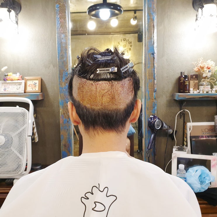  비절개 모발이식 뒷머리 커버