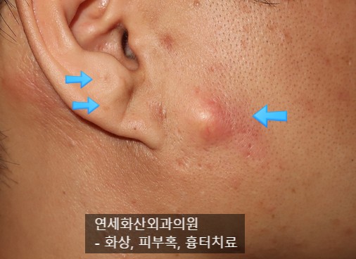 연세화산외과] 귓볼과 귀 앞부분에 생긴 다발성 피지낭종 수술 - 귓볼에서도 뭔가가 만져져요 -- 서울 송파구 외과 : 네이버 블로그