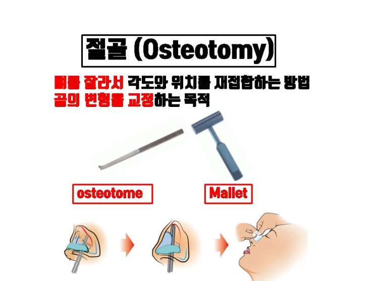  반드시 코절골술을 해야만 교정이 가능한 코의 변형 2 가지