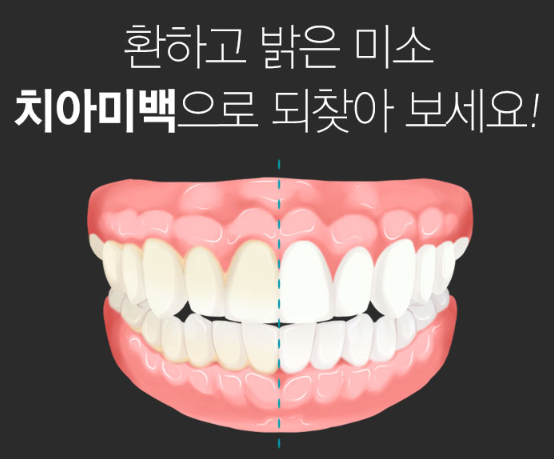 야탑역치과추천 착색된 치아미백으로 개선한 케이스 3