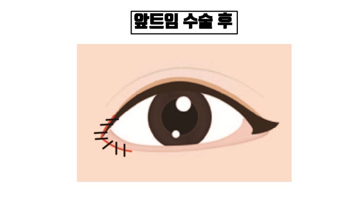  몽고주름 교정 시 눈에 띄지 않는 봉합실로 앞트임, 위트임을 할 수 없나요?