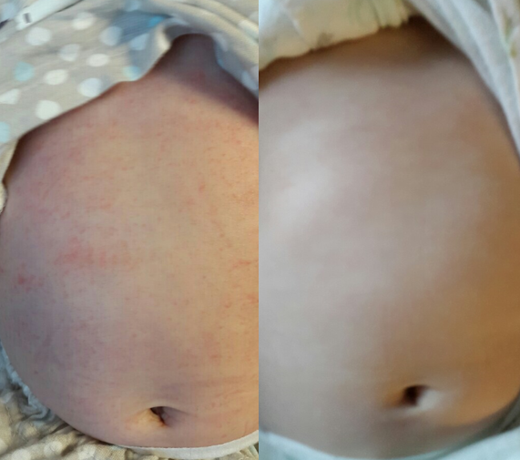  돌전아기피부발진 연고사용 전 꼭 읽어보세요