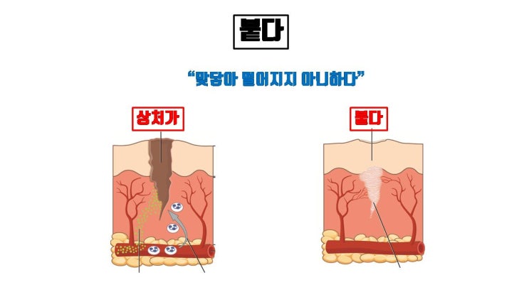  앞트임, 뒤트임하면 무조건 붙는다는데 사실인가요?