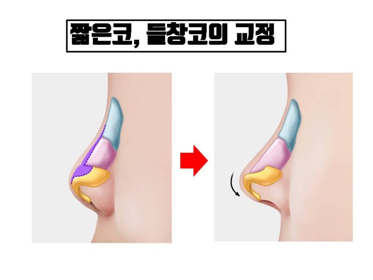  비중격연장술 대신 귀연골을 사용한 짧은코 수술 후에는 코끝이 자연스럽게 움직인다던 데요.