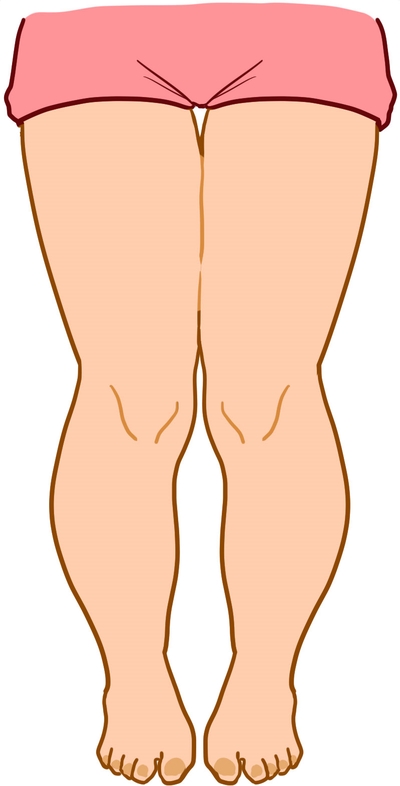  지방흡입 II : 지방흡입을 한 후 출근 바로 가능할까요?
