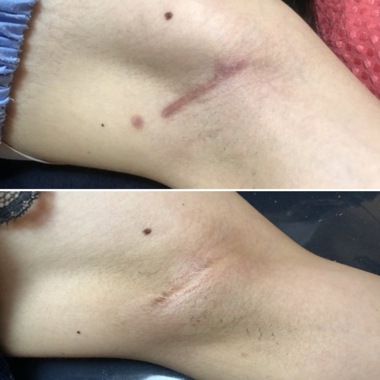  겨드랑이색소침착, 가슴수술흉터자국, 겨드랑이흉터는 하이스킨