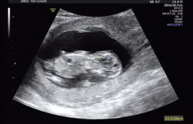 [임신 12주차(2)]1차 기형아검사/항목/금액/시기/결과/기형예방
