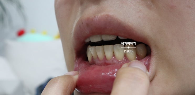  잇몸 내려앉음 치료 2년차 후기(내돈내산)