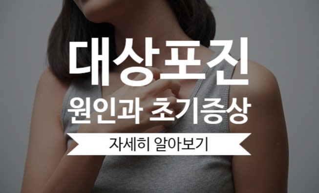 대상포진 증상(초기) 및 원인과 4