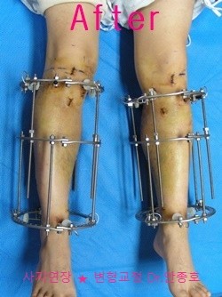  키성장과 수술