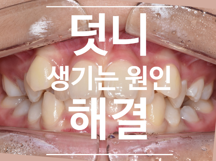 덧니가 생기는 이유, 유치가 조기에 상실되면 발생되는 일들, 덧니 안되게 하는 방법 덧니가 생기는 이유, 유치가 조기에 상실되면 발생되는 일들, 덧니 안되게 하는 방법