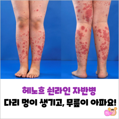  헤노흐 쇤라인 자반병(알레르기성 자반증), 다리에 멍이 생기고 무릎이 아파요!