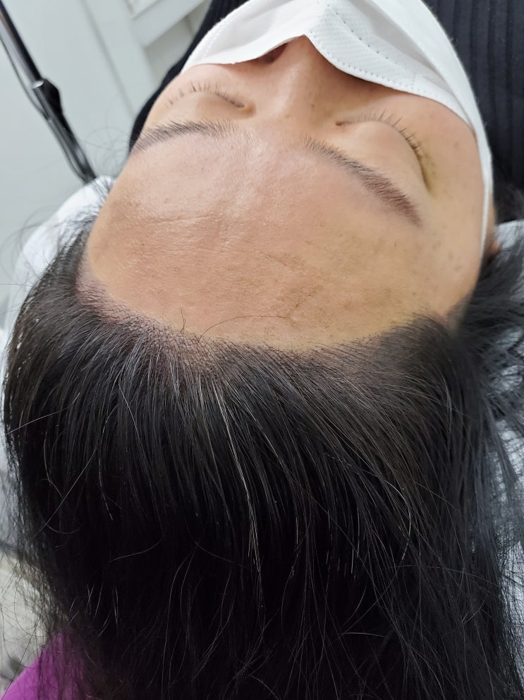  울산헤어라인 잔흔커버까지 감쪽같이 딱이야