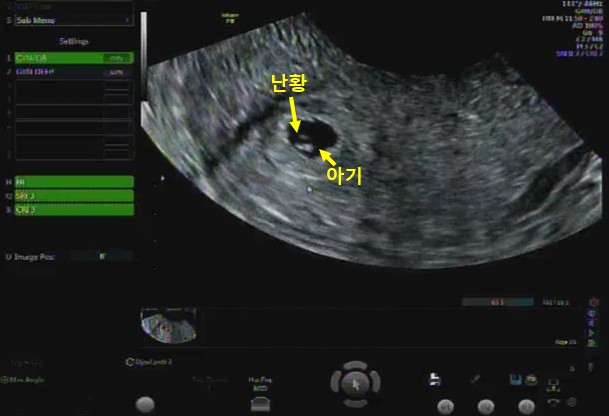 [임신일기1] 시험관 동결 5일배양 20일째 첫 초음파, 아기집과 난황을 보다