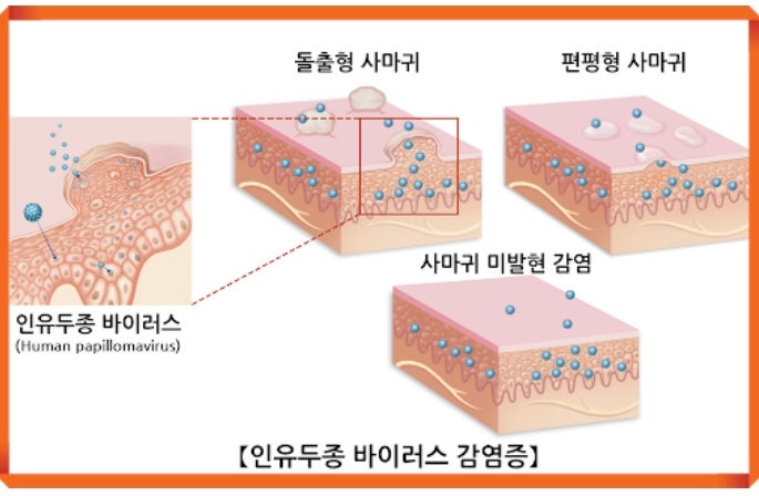 여자 생식기 피지낭종 원인과 구별방법 ?