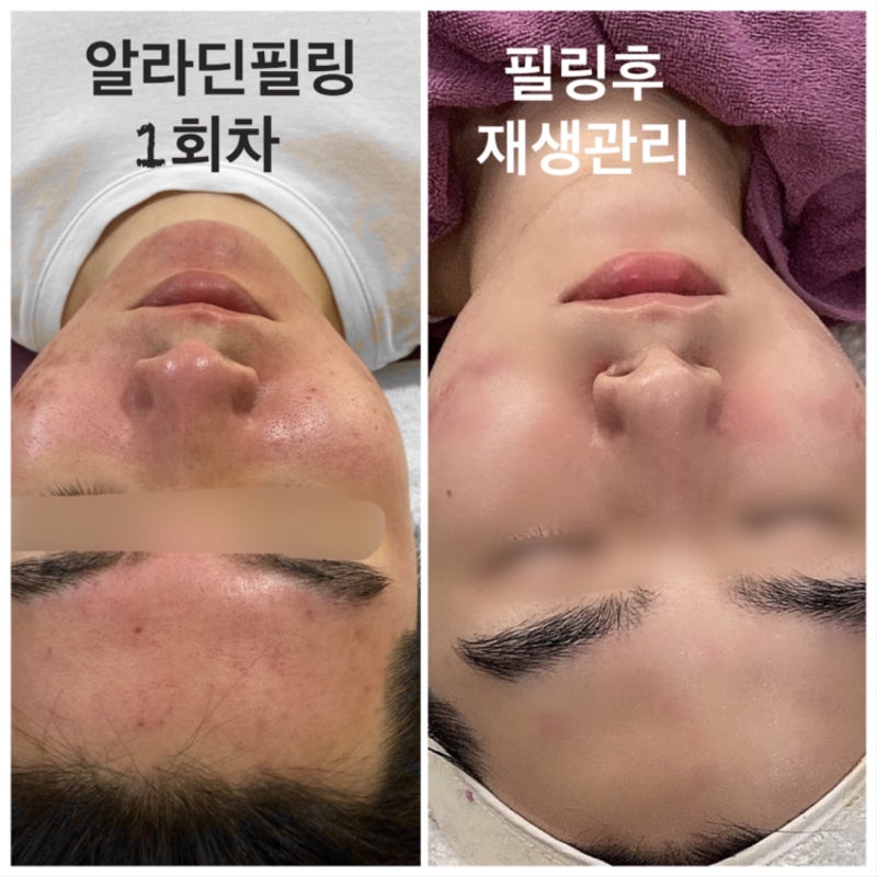 알라딘, 필링 시술 후 진정 재생 관리 마스크 추천 3