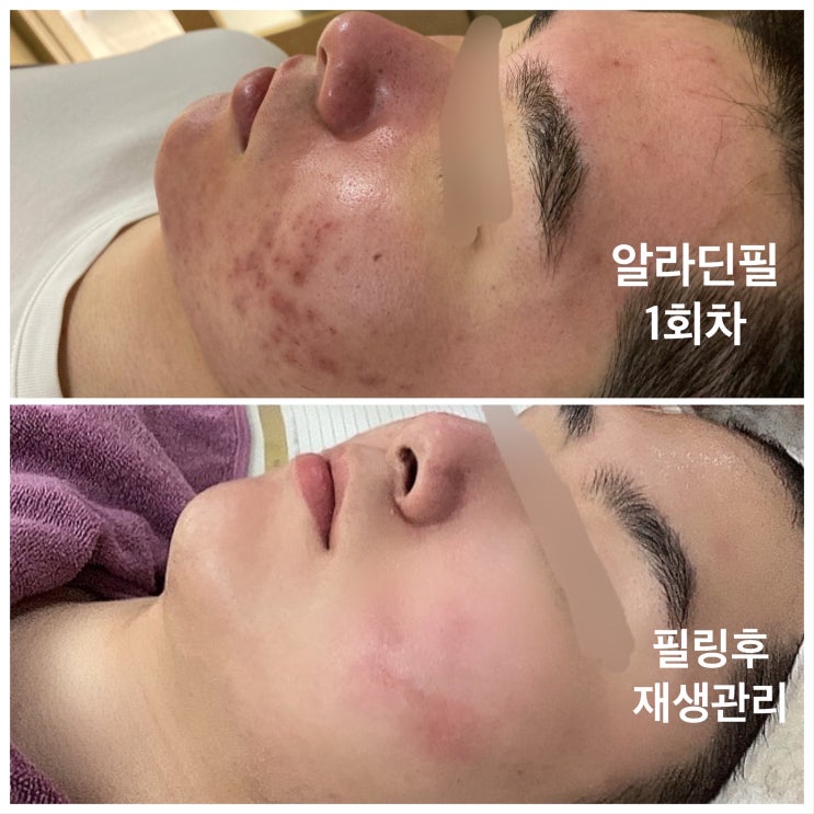 알라딘, 필링 시술 후 진정 재생 관리 마스크 추천 2