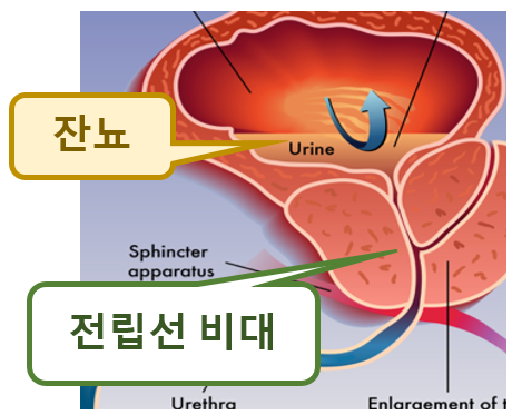 소변 후 잔뇨를 느끼면 2