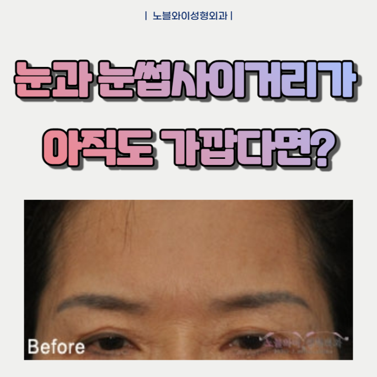  이마거상술재수술 눈과 눈썹사이 거리가 아직도