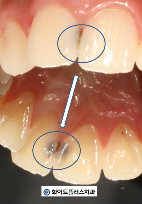 신풍역, 신길뉴타운 앞니 사이 틈새 충치 레진 치료