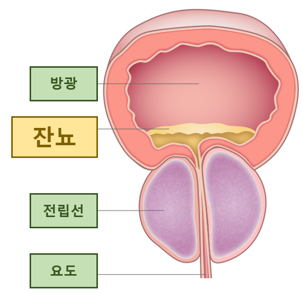 소변 후 잔뇨를 느끼면