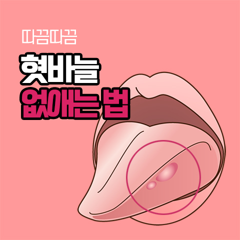  혓바늘 없애는법, 원인 파악이 우선