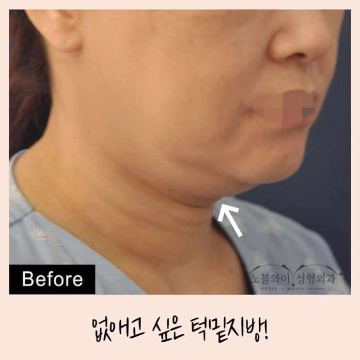  턱밑지방제거 몸무게 늘어도 브이라인