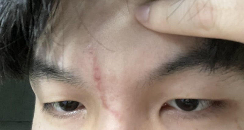 어린이 흉터 수술, 도그이어 제거 수술 국소 마취 및 낮잠 수술 리뷰 3