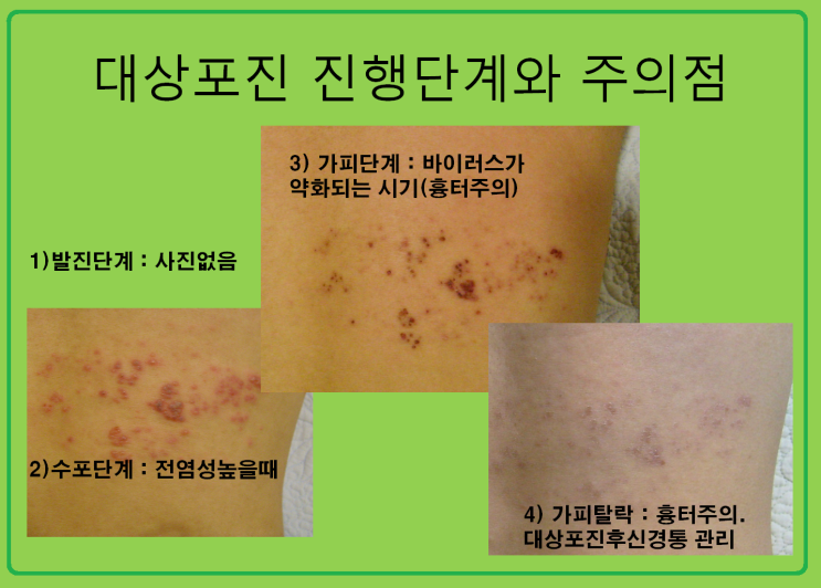  대상포진은 전염도 되나요? 감염되었는데 전염이 된다면 어떻게 해야 하나요?
