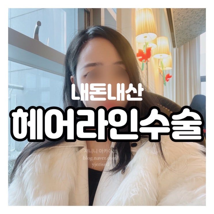  여자 넓은이마 헤어라인교정 수술! 모발이식 결심한 이유 (내돈내산)