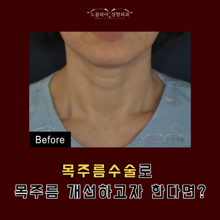  목주름수술비용 보다 이게 중요해