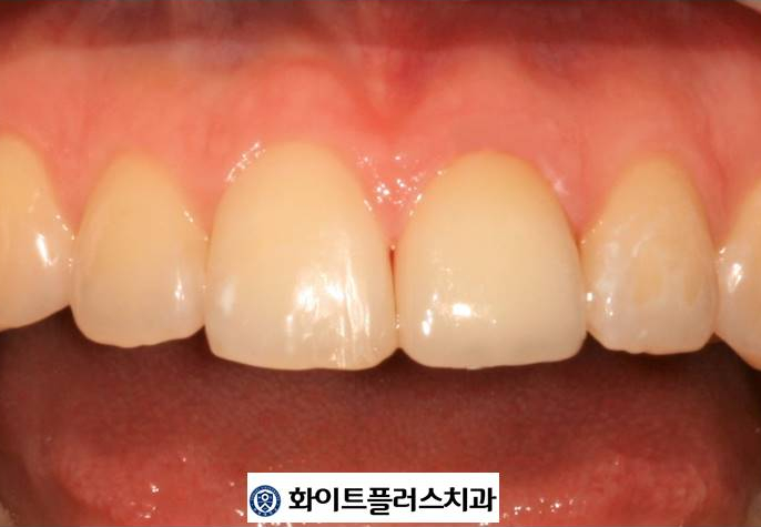  보라매 치과, 앞니 깨짐으로 레진 했던 치아 크라운으로 다시 하기