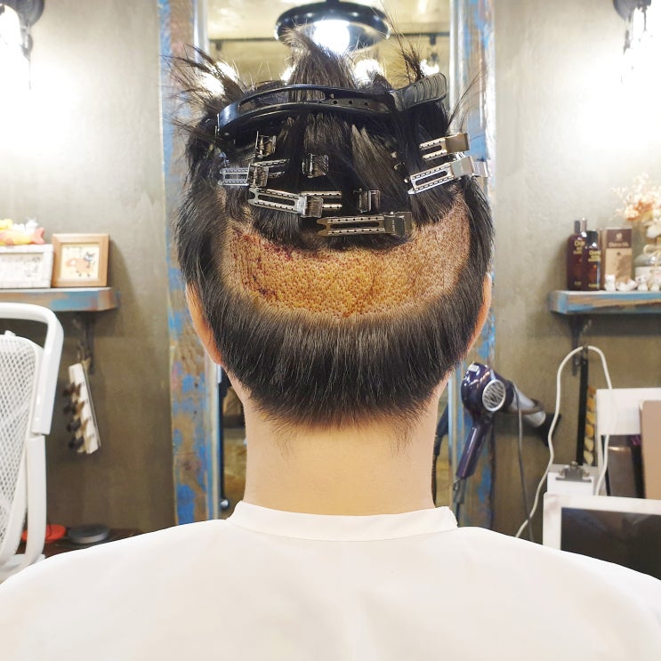  모발이식 후 미용실 언제 가면 될까?