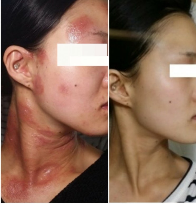  습진 진물을 멈추는 보습제와 관리방법