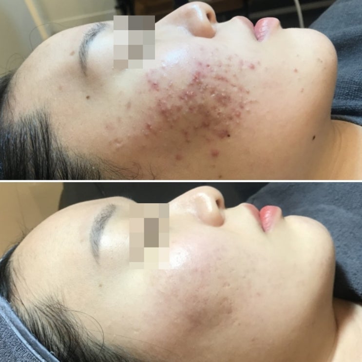  여드름흉터관리, 여드름색소침착관리, 여드름색소필링은 구로디지털단지피부관리 하이스킨에서-