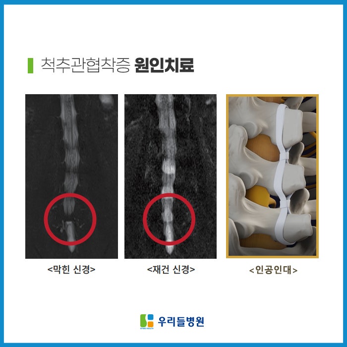 우리들병원 학술대회 디스크 캘러스 증후군 및 중증 퇴행성 디스크 환자의 허리디스크 내시경 수술 및 인대 재건술 2