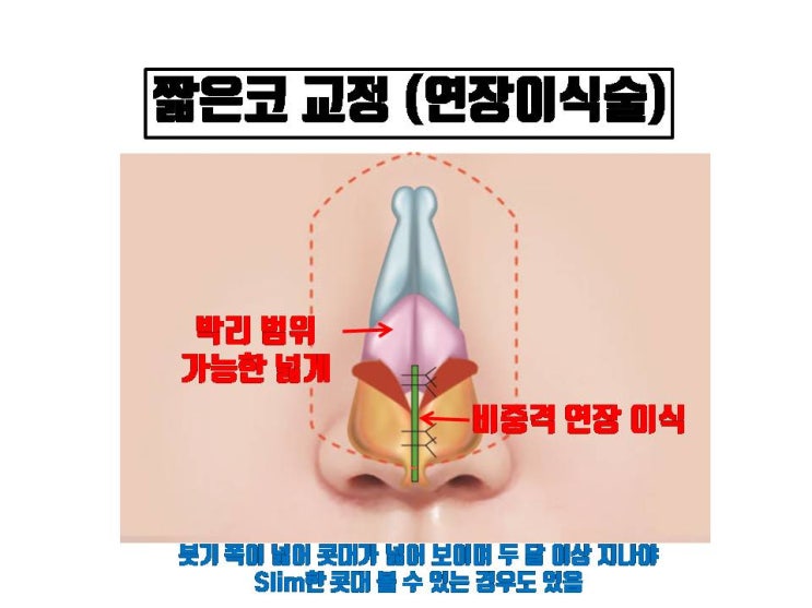  코수술 마다 코보형물 넣는 포켓, 귀연골이나 비중격 연골을 이식하는 공간의 크기가 달라서 붓기의 정도도 달라요.