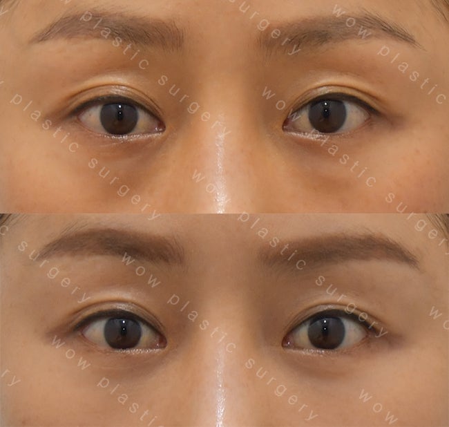 눈밑지방재배치 멍, 붓기가 걱정될