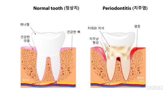  치주질환이란 무엇일까?