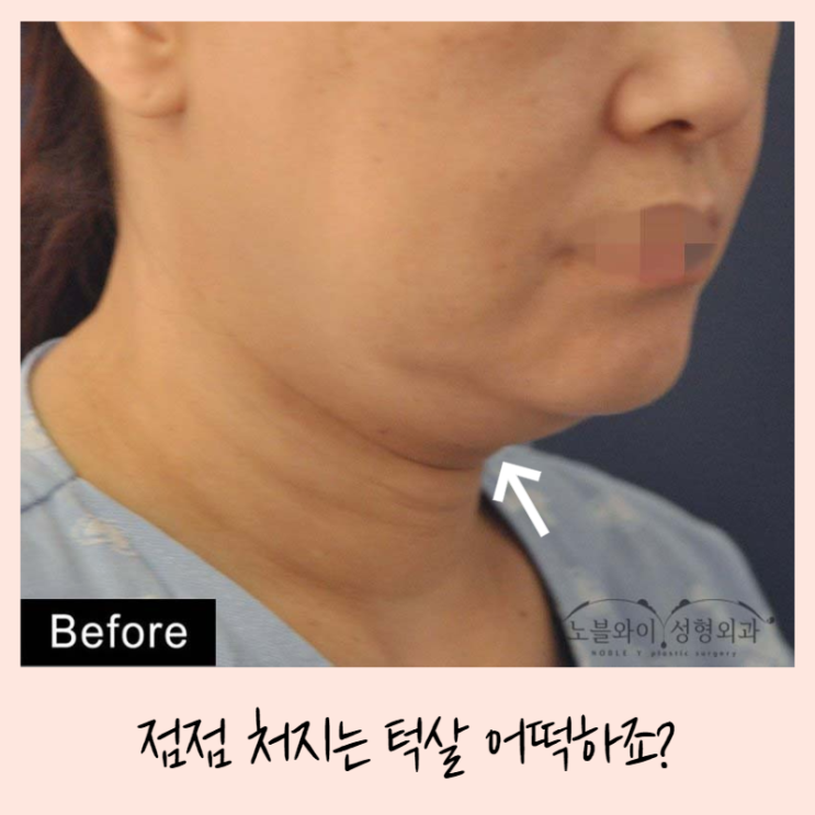  얼굴턱살처짐 턱밑근육이 문제