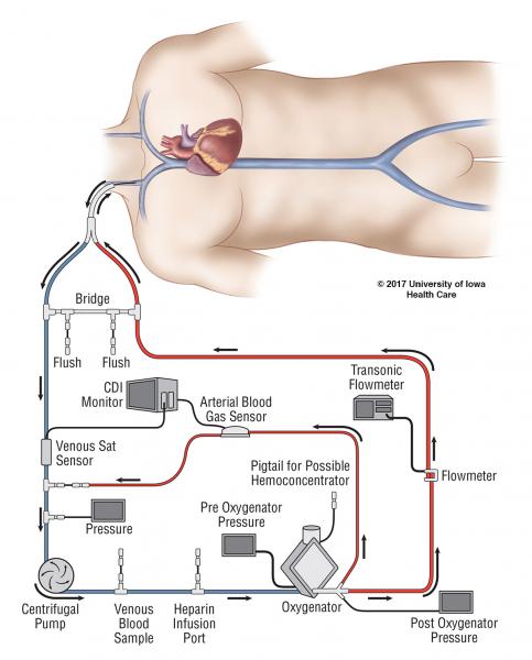  미국 코로나 치료비 15억, 독일은 에크모(ECMO) 시술도 무료