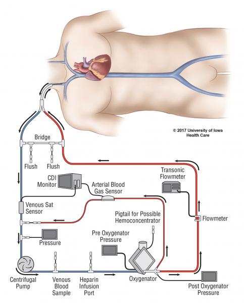 미국 코로나 치료비 15억, 독일은 에크모(ECMO) 시술도 무료