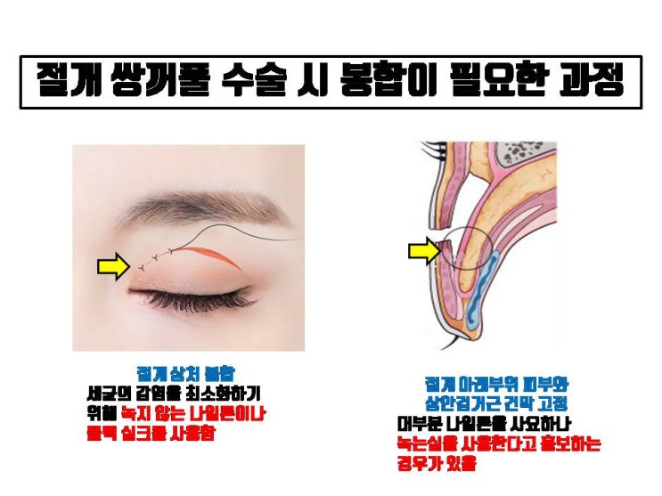 녹는 실로 쌍수하면 좋은 점 하나 없어요!!!