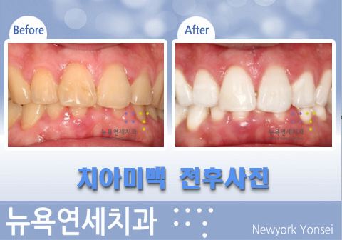 황니를 치과의 전문가 치아미백으로 치료 한 전후사진!