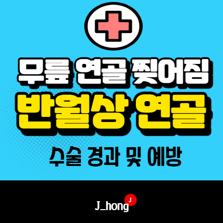  [무릎 연골 찢어짐] 수술 2회 경험, 경과 및 예방법 알아봐요!