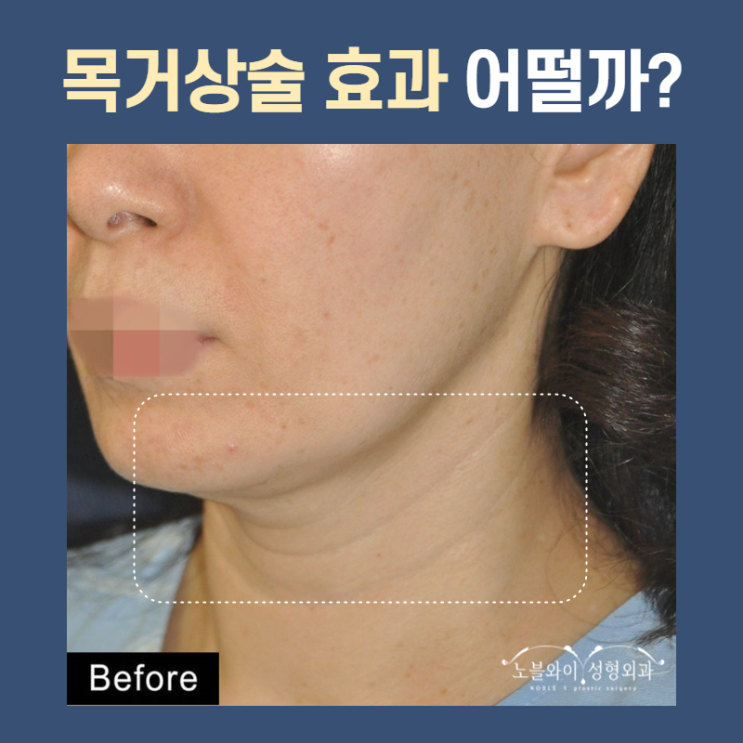  목거상술효과 둘레도 줄어