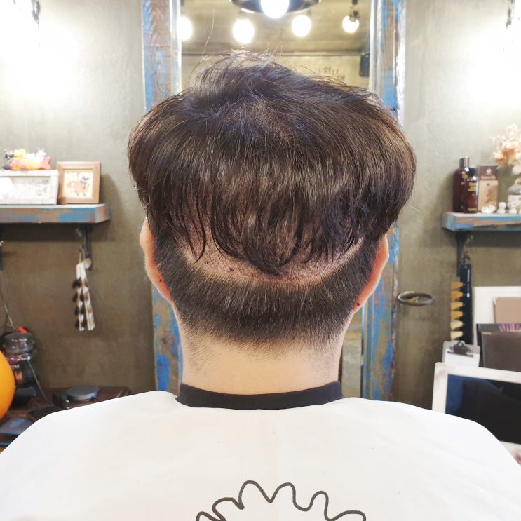  모발이식 뒤통수 머리숱증모 커버